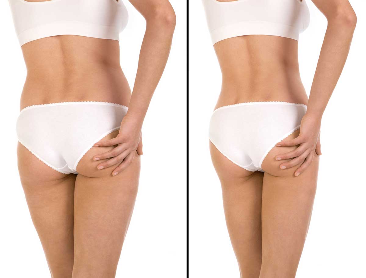 Anticellulite Montigny le Bretonneux